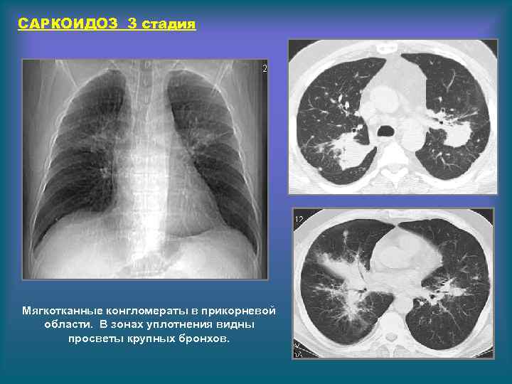 Мягкотканные образования в легких: причины, симптомы, диагностика и лечение