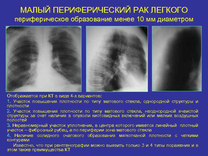 Мягкотканные образования в легких: причины, симптомы, диагностика и лечение