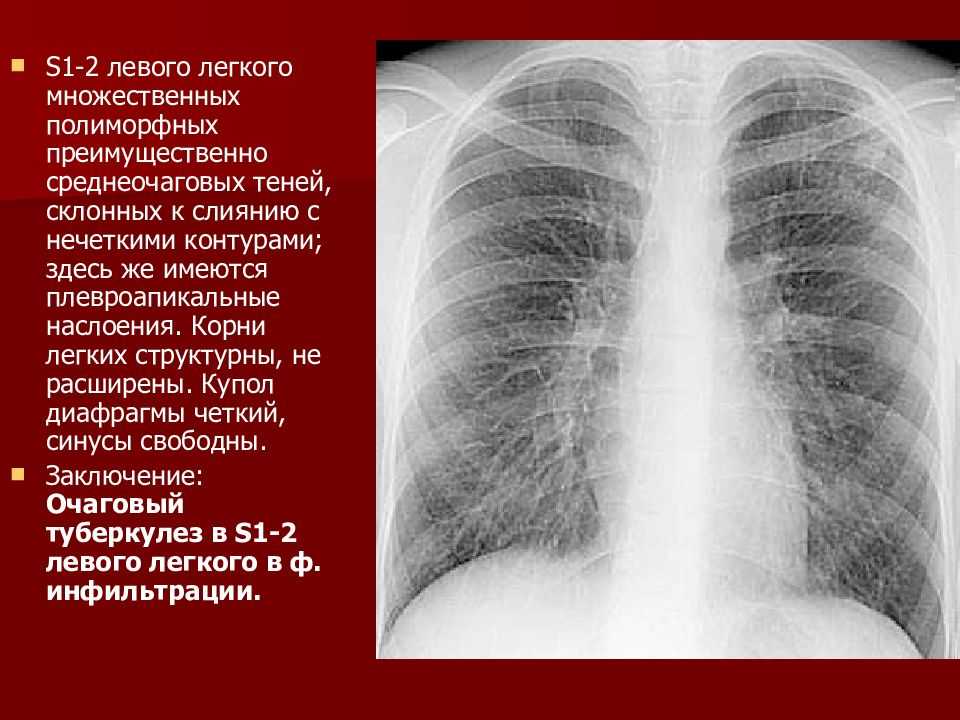 Мягкотканный компонент опухоли что это
