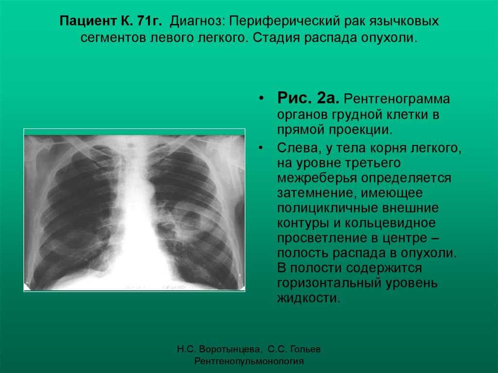 Что такое единичные мягкотканные очажки в легких?